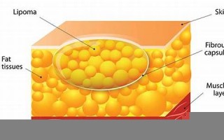 lipoma什么意思,lipoma中文翻译,lipoma用法及例句,lipoma怎么读